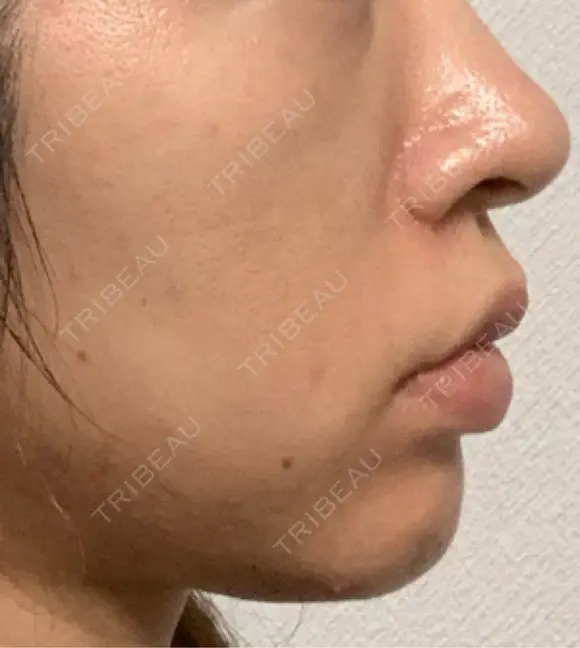 ヒアルロン酸注入（頬） eクリニック 金沢本院 DAY 67 メイン用