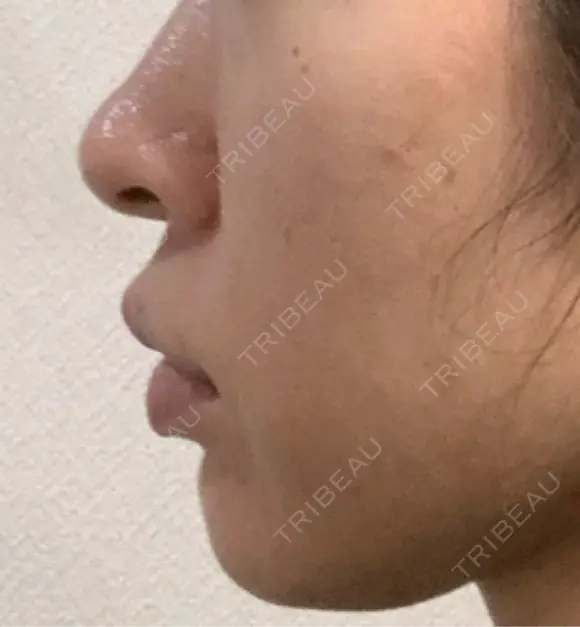 ヒアルロン酸注入（頬） eクリニック 金沢本院 DAY 67 メイン用