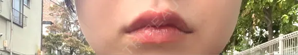 ヒアルロン酸注入（唇） 目白ホワイトクリニック AFTER メイン用