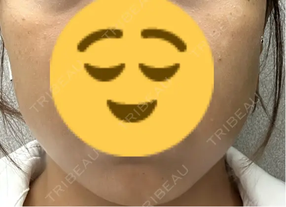 ボトックス（エラ・小顔） 共立美容外科 梅田院 DAY 1 メイン用