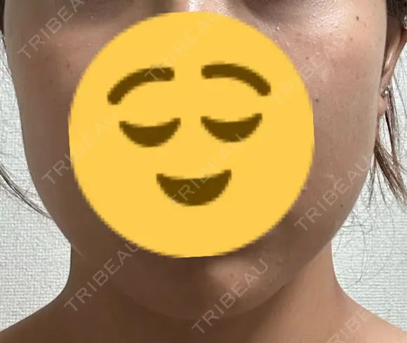 ボトックス（エラ・小顔） 共立美容外科 梅田院 DAY 2 メイン用