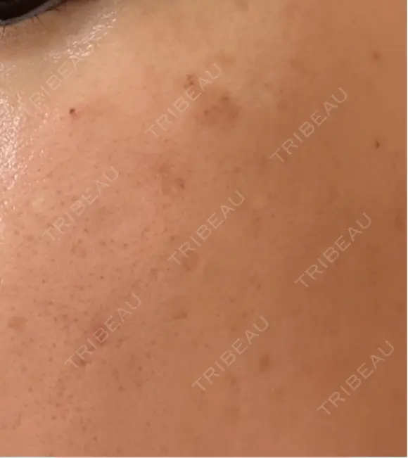 ルメッカ Clinic K Blossom DAY 1 メイン用