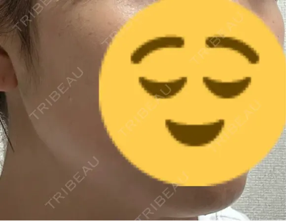 ボトックス（エラ・小顔） 共立美容外科 梅田院 DAY 3 メイン用