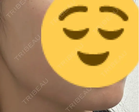 ボトックス（エラ・小顔） 共立美容外科 梅田院 DAY 4 メイン用