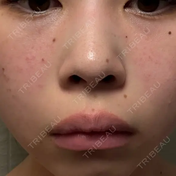 ルメッカ ルラ美容クリニック 大宮院 / ルラスキンクリニック 大宮院 DAY 8 メイン用