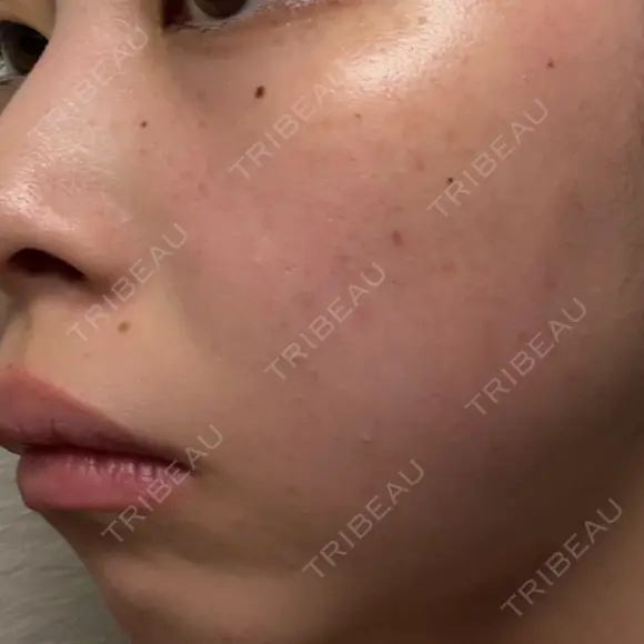 ルメッカ ルラ美容クリニック 大宮院 / ルラスキンクリニック 大宮院 DAY 8 メイン用