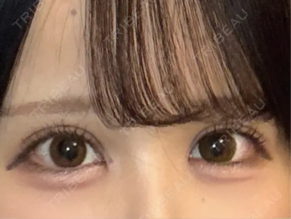 二重埋没 / 目頭切開 東京シンデレラ美容外科 池袋院 DAY 7 メイン用