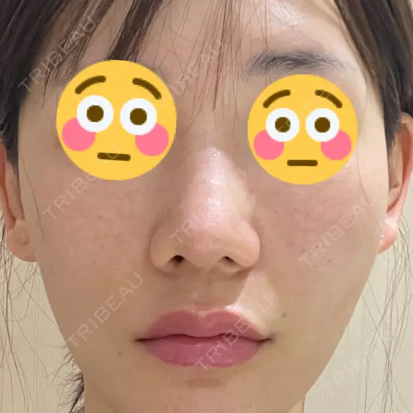 肌育注射（ジュベルックなど） / イオン導入 / ピーリング（ハリ・ツヤ） ゆう美容クリニック AFTER メイン用