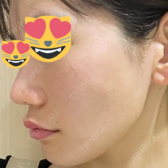 肌育注射（ジュベルックなど） / イオン導入 / ピーリング（ハリ・ツヤ） ゆう美容クリニック DAY 14 メイン用