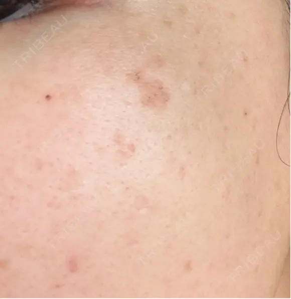 ルメッカ Clinic K Blossom DAY 2 メイン用