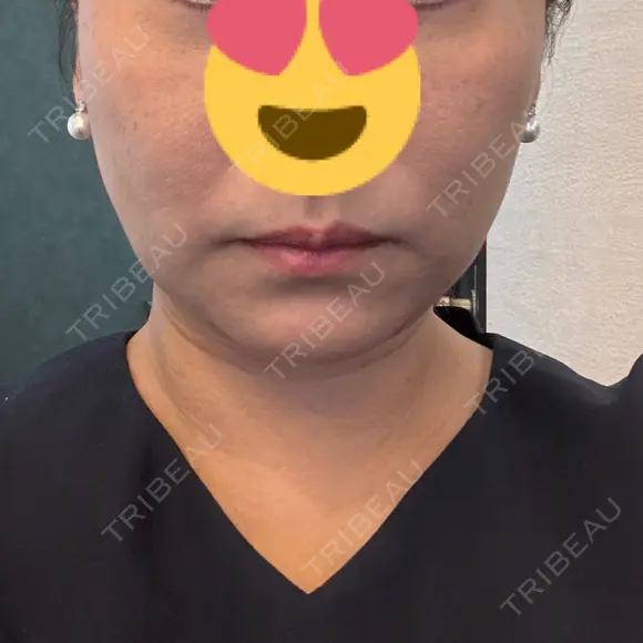 糸リフト / 脂肪吸引注射（顔） 新宿美容外科ネビュラクリニック DAY 15 メイン用