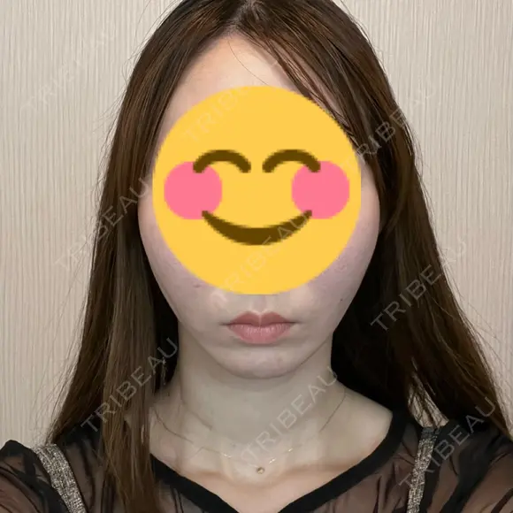 糸リフト 藤・ナチュレ美容クリニック 銀座院 DAY 0 メイン用