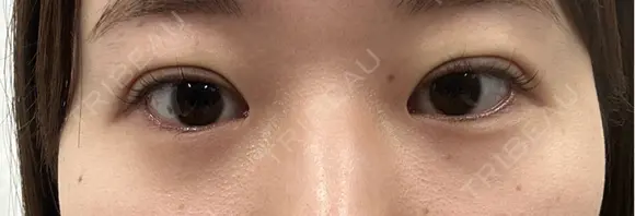 二重埋没 eクリニック 横浜みなとみらい院 DAY 0 メイン用