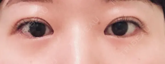 二重埋没 eクリニック 横浜みなとみらい院 DAY 1 メイン用