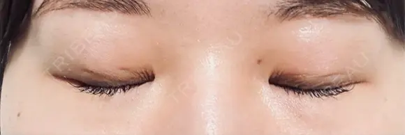 二重埋没 eクリニック 横浜みなとみらい院 DAY 1 メイン用