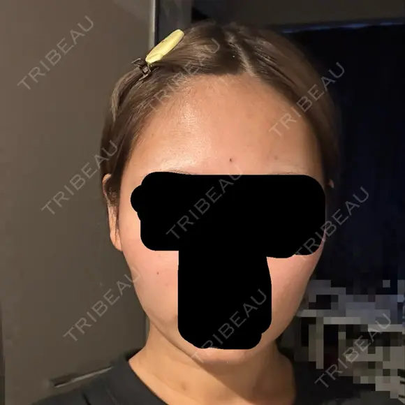 ボトックス（エラ・小顔） 札幌TAクリニック DAY 6 メイン用