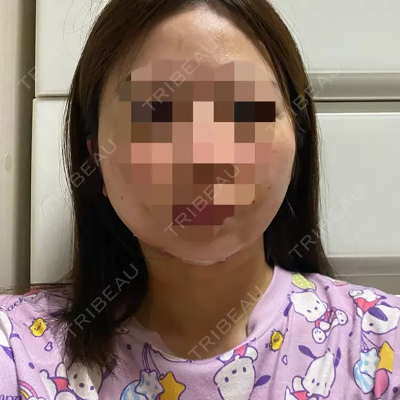 糸リフト / 脂肪吸引（顔） / ジョールファット除去 GRACIA clinic 【グラシアクリニック】 DAY 1 メイン用