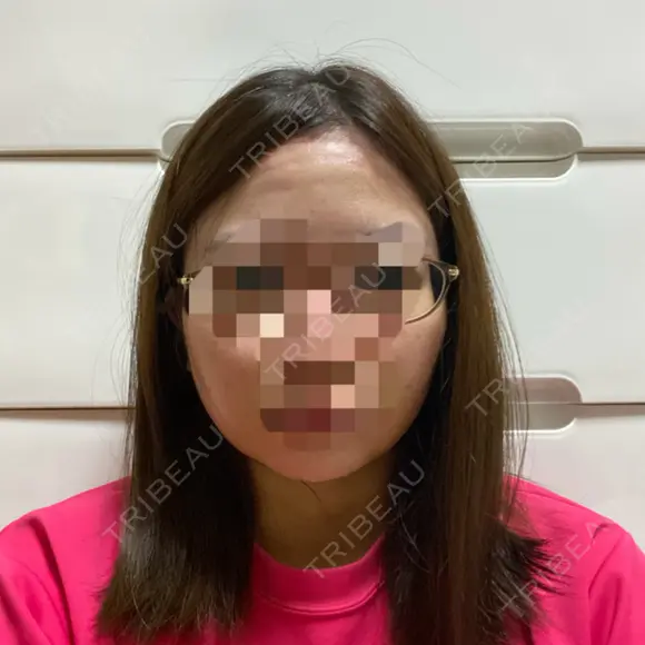 糸リフト / 脂肪吸引（顔） / ジョールファット除去 GRACIA clinic 【グラシアクリニック】 DAY 2 メイン用