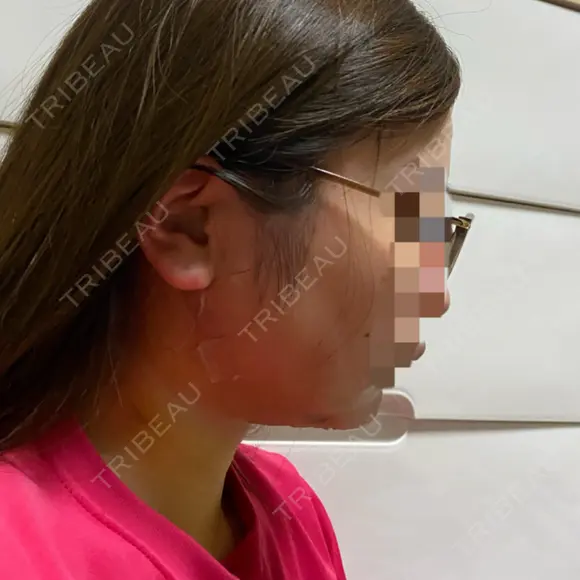 糸リフト / 脂肪吸引（顔） / ジョールファット除去 GRACIA clinic 【グラシアクリニック】 DAY 2 メイン用