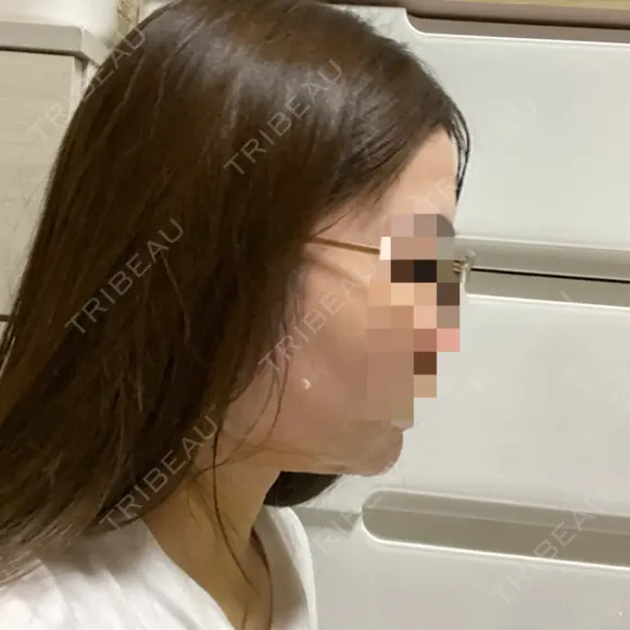 糸リフト / 脂肪吸引（顔） / ジョールファット除去 GRACIA clinic 【グラシアクリニック】 DAY 3 メイン用