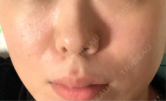 リジュラン 新宿Ladies&Gentlemen美容クリニック AFTER メイン用