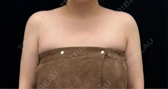 脂肪吸引（二の腕） EMMA CLINIC（エマクリニック） DAY 106 メイン用