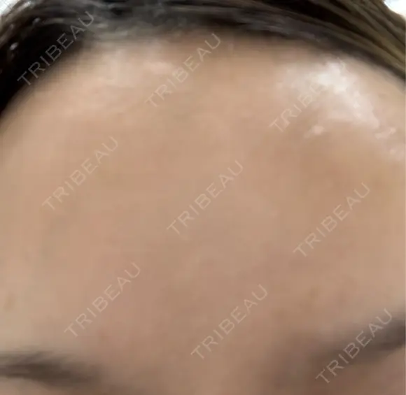 ボトックス（あご） / ボトックス（眉間） / ボトックス（目尻） / ボトックス（額） TCB東京中央美容外科 名古屋栄院 AFTER メイン用