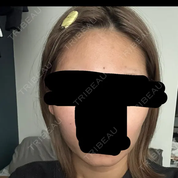 ボトックス（エラ・小顔） 札幌TAクリニック DAY 7 メイン用