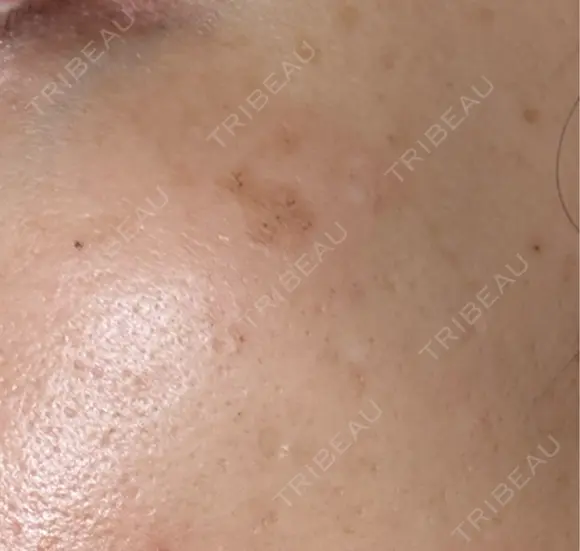 ルメッカ Clinic K Blossom DAY 3 メイン用