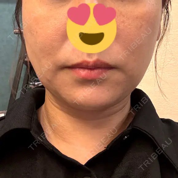 糸リフト / 脂肪吸引注射（顔） 新宿美容外科ネビュラクリニック DAY 16 メイン用