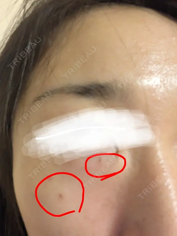 シミ取りレーザー さっぽろ美容クリニック DAY 0 メイン用