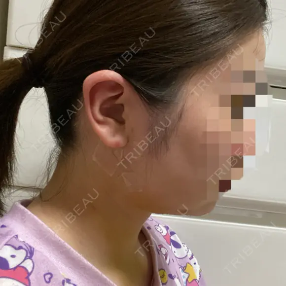 糸リフト / 脂肪吸引（顔） / ジョールファット除去 GRACIA clinic 【グラシアクリニック】 DAY 4 メイン用