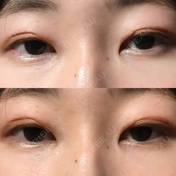 二重切開 表参道スキンクリニック 表参道院 DAY 100 メイン用