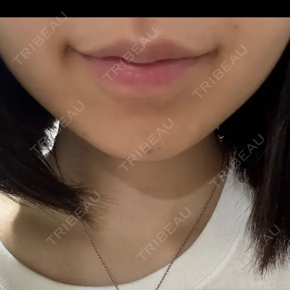 ボトックス（あご） / ボトックス（口角） DMTC CLINIC 渋谷院 DAY 1 メイン用