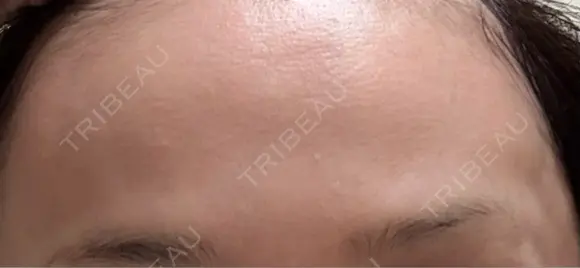 ボトックス（目尻） / ボトックス（額） ルラ美容クリニック 千葉院 / ルラスキンクリニック 千葉院 AFTER メイン用