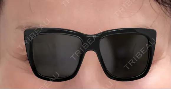 ボトックス（目尻） / ボトックス（額） ルラ美容クリニック 千葉院 / ルラスキンクリニック 千葉院 DAY 11 メイン用