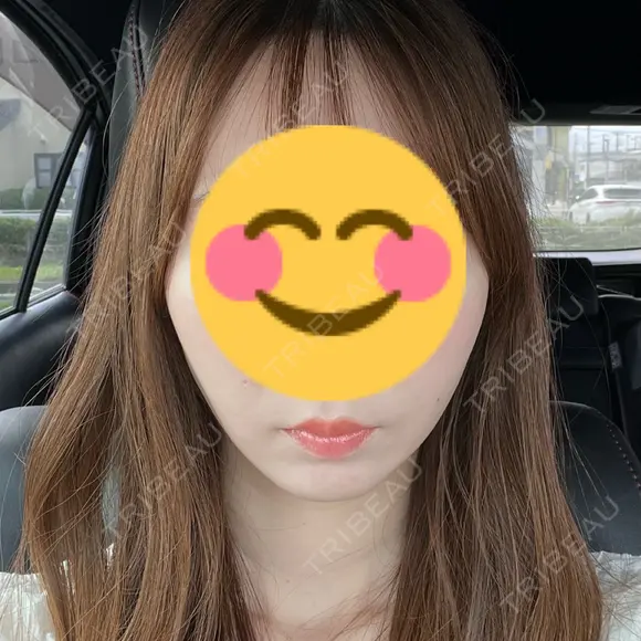 糸リフト 藤・ナチュレ美容クリニック 銀座院 DAY 2 メイン用