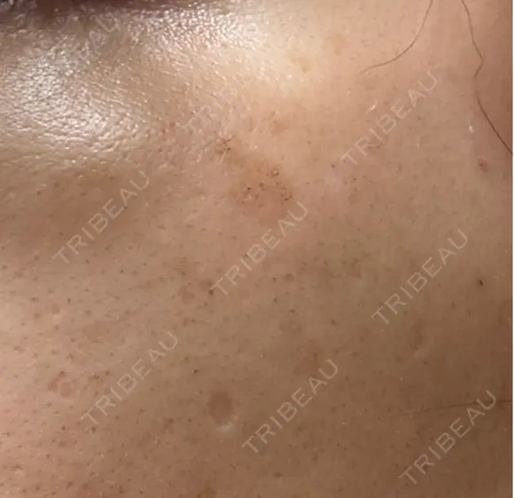 ルメッカ Clinic K Blossom DAY 4 メイン用