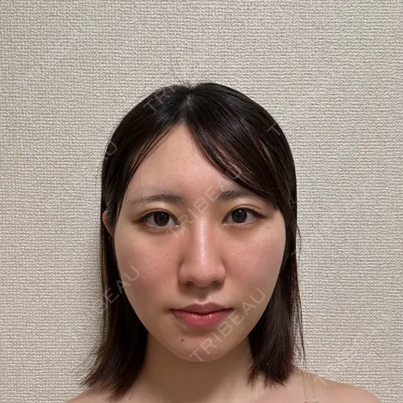 糸リフト / バッカルファット除去 / 脂肪吸引（顔） / メーラーファット除去 / ジョールファット除去 / ボトックス（あご） First Clinic DAY 14 メイン用