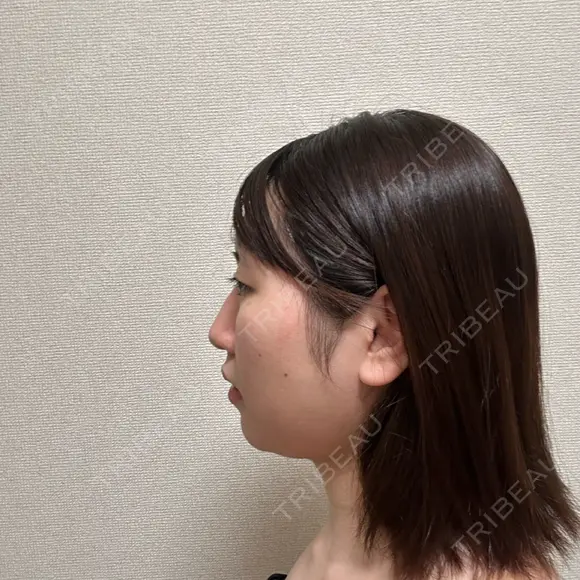 糸リフト / バッカルファット除去 / 脂肪吸引（顔） / メーラーファット除去 / ジョールファット除去 / ボトックス（あご） First Clinic DAY 14 メイン用