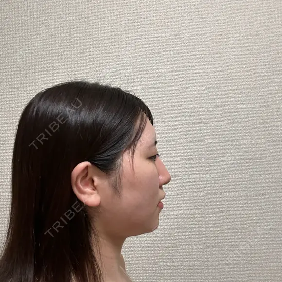 糸リフト / バッカルファット除去 / 脂肪吸引（顔） / メーラーファット除去 / ジョールファット除去 / ボトックス（あご） First Clinic DAY 14 メイン用