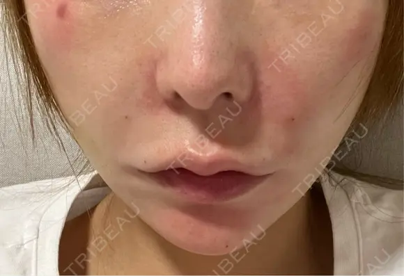 ボトックス（口角） / ボトックス（タレ目） / ボトックス（目尻） / ボトックス（額） / ボトックス（人中） / ヒアルロン酸注入（鼻翼基部） / ボトックス（バニーライン） KIMI CLINIC 形成・美容外科 AFTER メイン用