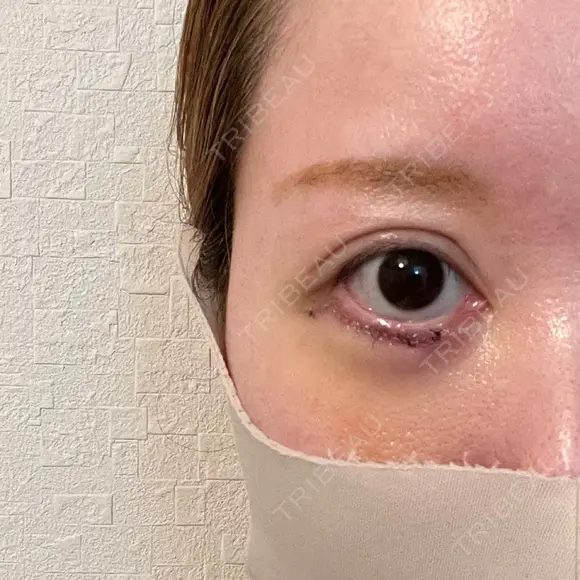 下まぶたたるみ取り / その他（目元） ネビュラクリニック 京都院 DAY 3 メイン用