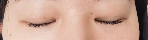 二重埋没 eクリニック 横浜みなとみらい院 DAY 3 メイン用