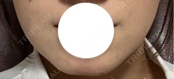 ボトックス（エラ・小顔） / ボトックス（二の腕） DMTC美容皮膚科 大宮院 AFTER メイン用