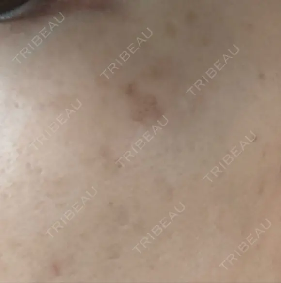 ルメッカ Clinic K Blossom DAY 5 メイン用