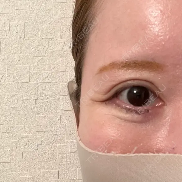 下まぶたたるみ取り / その他（目元） ネビュラクリニック 京都院 DAY 4 メイン用