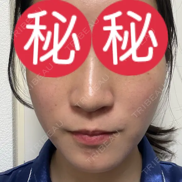 ピコレーザートーニング（美白・肝斑） / ピコフラクショナルレーザー（毛穴・ニキビ跡） / ピコスポット 東京シルククリニック 東京神田院 AFTER メイン用