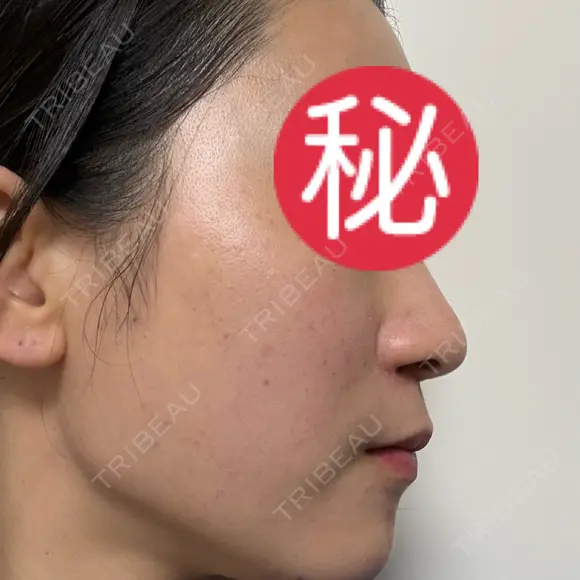 ピコレーザートーニング（美白・肝斑） / ピコフラクショナルレーザー（毛穴・ニキビ跡） / ピコスポット 東京シルククリニック 東京神田院 DAY 7 メイン用