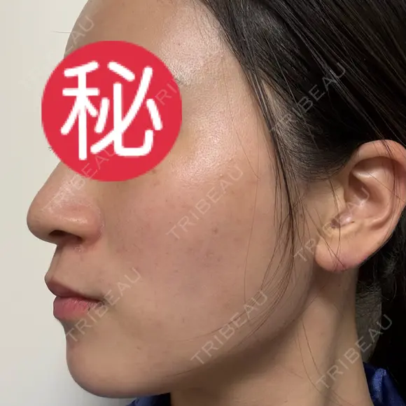 ピコレーザートーニング（美白・肝斑） / ピコフラクショナルレーザー（毛穴・ニキビ跡） / ピコスポット 東京シルククリニック 東京神田院 DAY 7 メイン用